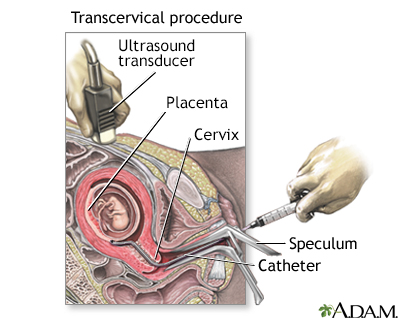 Procedure, part 2 - transcervical