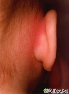 Mastoiditis - redness and swelling behind ear