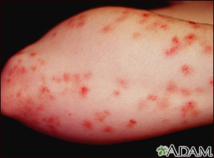 Dermatitis herpetiformis on the forearm