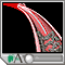 Balloon angioplasty - short segment