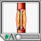 Percutaneous transluminal coronary angioplasty (PTCA)