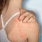 What are hives?