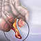 Appendectomy