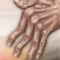 Rheumatoid arthritis