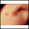 Urticaria pigmentosa in the armpit