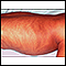 Incontinentia pigmenti - side