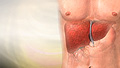 Alcoholic liver disease