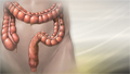 Irritable bowel syndrome