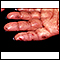 Dermatitis herpetiformis on the hand