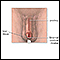 Meatal stenosis